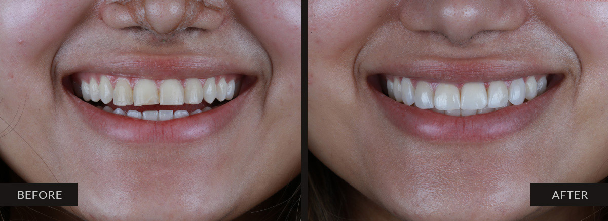 guatemala dental before after 13