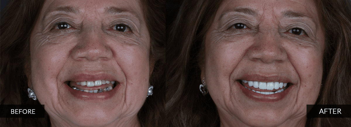 happy patinet before and after dental treatment