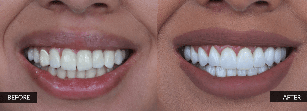 happy patinet before and after dental treatment