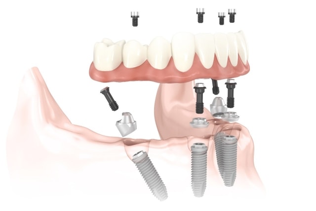3d diagram of All-on dental implants