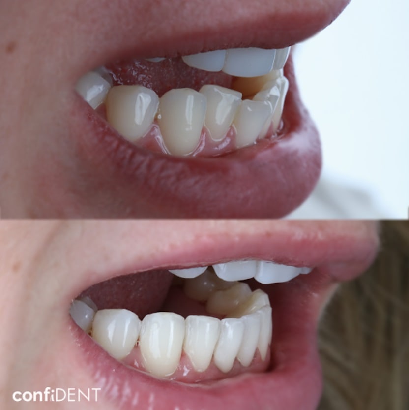 Get straight teeth with clear aligners
