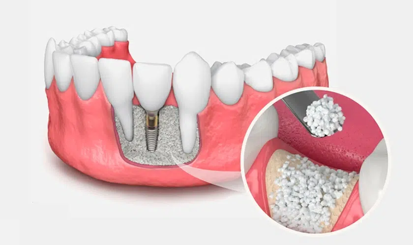autologous bone grafting implant