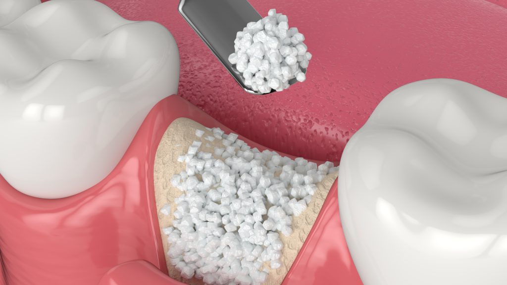 guatemala dental autologous bone grafting process