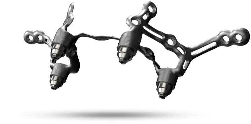 An upper custom subperiosteal implant