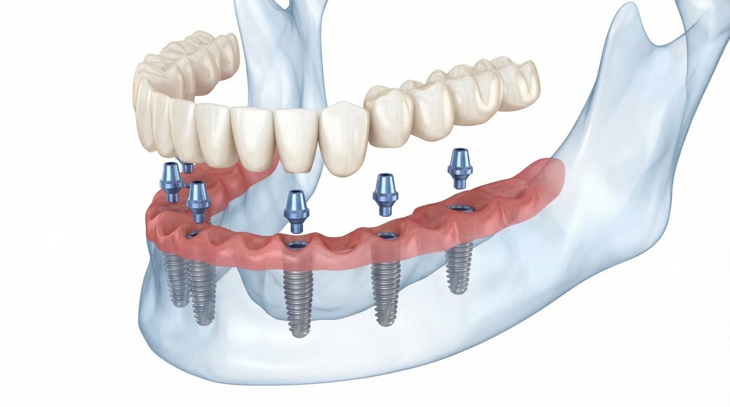 guatemala dental full arch dental implants 3-on-6